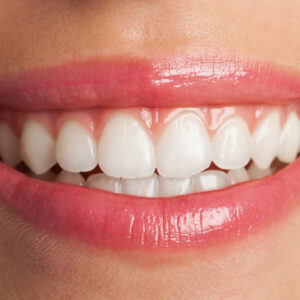 A imagem mostra um sorriso com clareamento dental