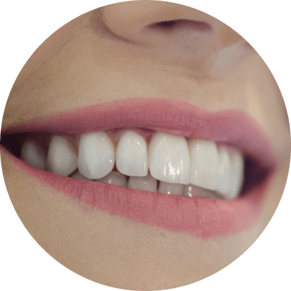 Facetas de Porcelana
