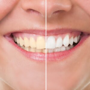Comparativo de uma boca com e sem clareamento dental