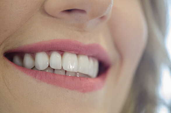 Quem-pode-utilizar-facetas-de-porcelana