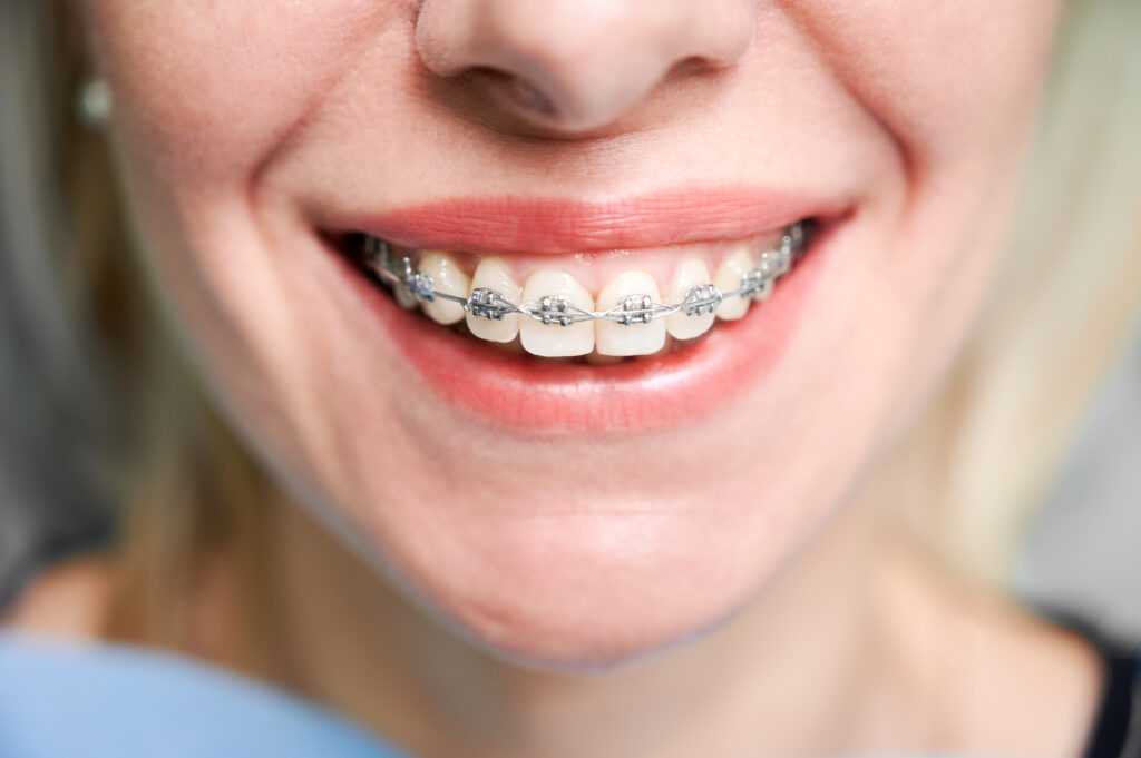 A imagem mostra uma pessoa que usa aparelho odontológico e mantém boas práticas de higiene bocal.